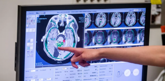 초음파 빔으로 “암 치료제 뇌에 보낸다”